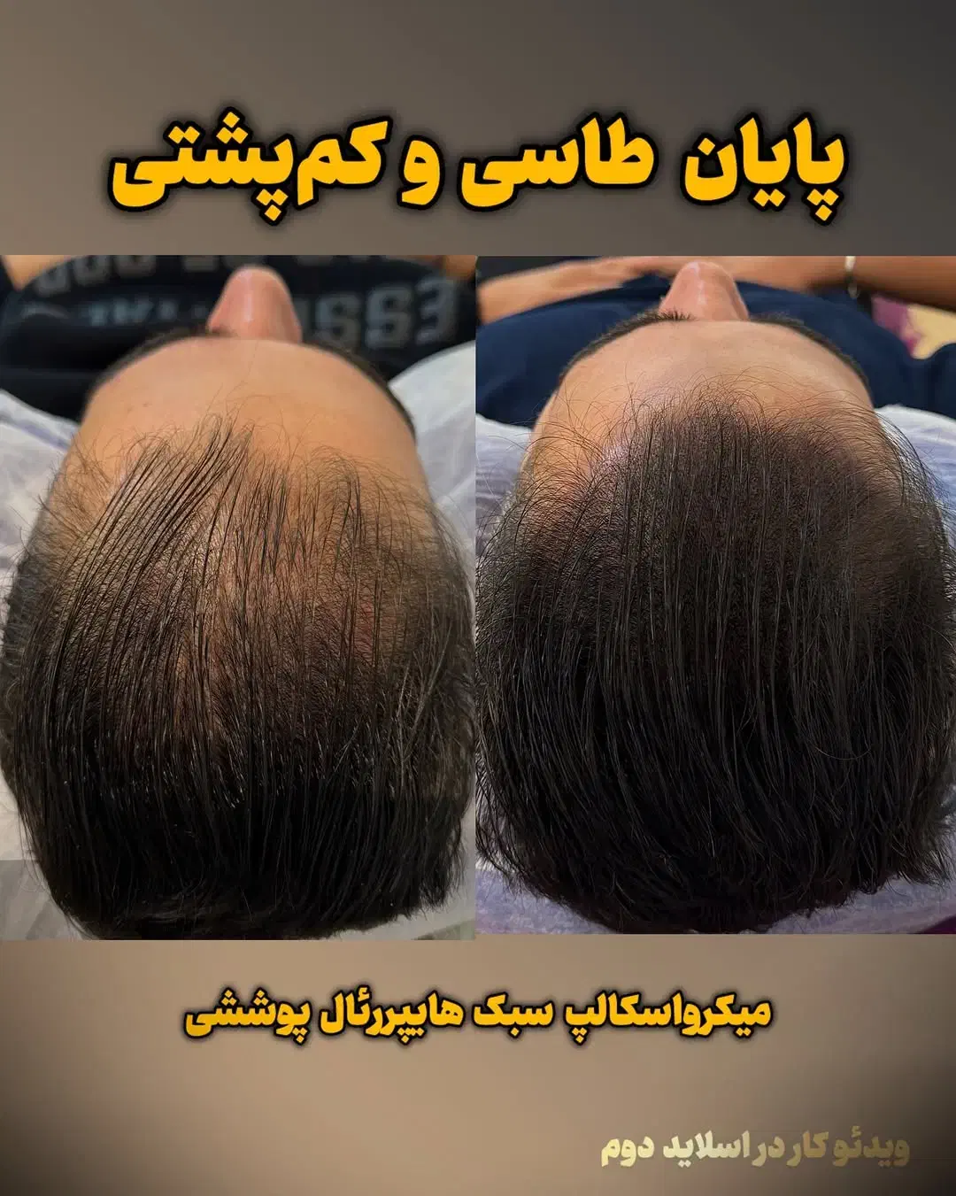 میکرو اسکالپ مکمل کاشت مو|خدمات آرایشگری و زیبایی|یاسوج, |دیوار