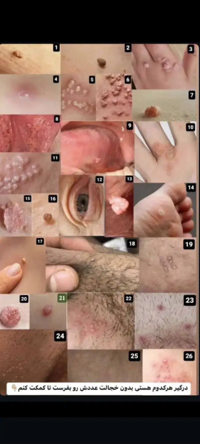 درمان زگیل تناسلی از ریشه|خدمات آرایشگری و زیبایی|اصفهان, کوهانستان|دیوار