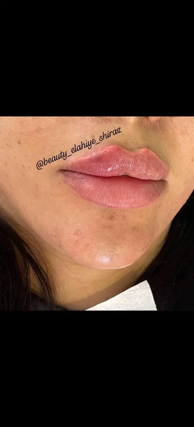 تزریق فیلر ،ژل و بوتاکس با دستگاه|خدمات آموزشی|شیراز, گویم|دیوار