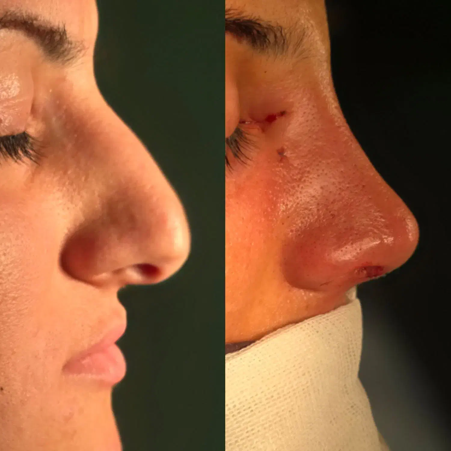 جراحی بینی و پلک، لیفت ابرو و شقیقه، لیفت صورت|خدمات آرایشگری و زیبایی|خوی, |دیوار