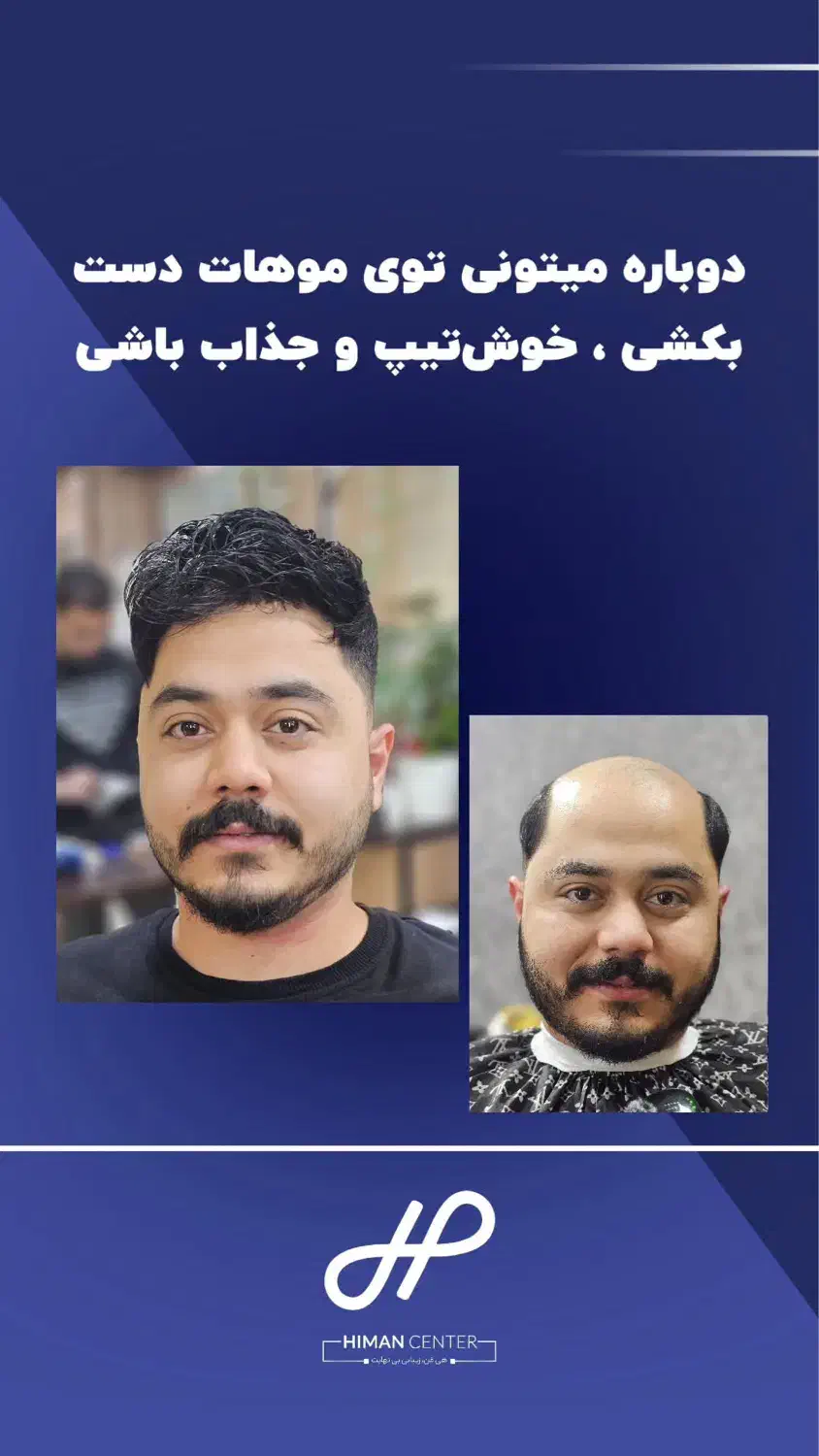 جایگزین مناسب کاشت مو (ترمیم مو)|آرایشی، بهداشتی، درمانی|اصفهان, دستگرده|دیوار