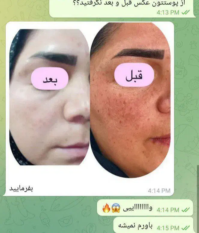 سرم نیاسینامید ضد لک وجوش|آرایشی، بهداشتی، درمانی|شیراز, باغ تخت|دیوار