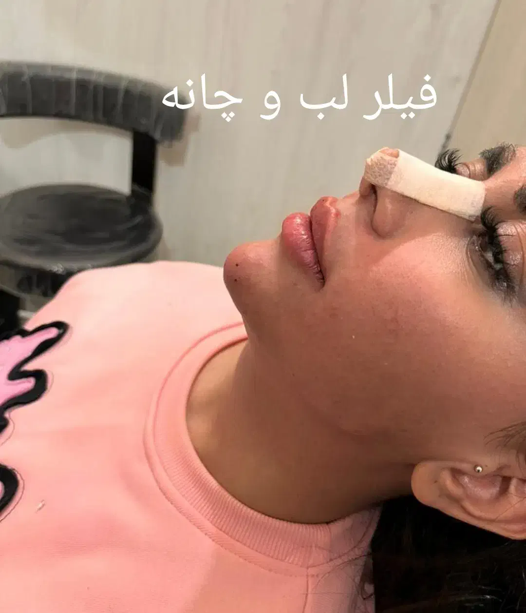 تزریق ژل بوتاکس نخ ...توسط پزشک در کلینیک سایماه|خدمات آرایشگری و زیبایی|کرمان, |دیوار