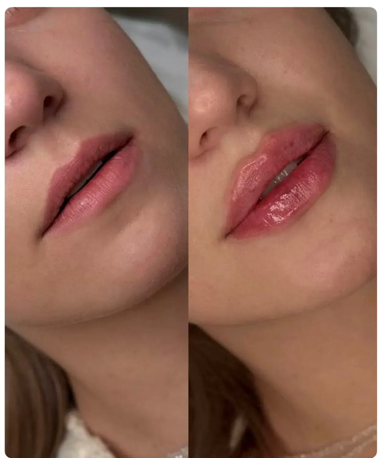 ژل بوتاکس مزوتراپی جوانساز فشیال پاکسازی|خدمات آرایشگری و زیبایی|اندیشه, اندیشه فاز ۱|دیوار