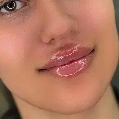 تزریقات ژل ،بوتاکس ،نخ با بهترین قیمت و متریال|خدمات زیبایی و سلامت|کرج, جهانشهر|دیوار