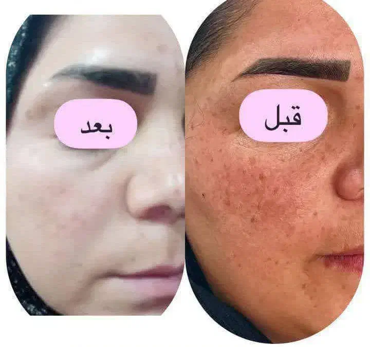 کرم سفید کننده مروه گلی یا همون القمر|آرایشی، بهداشتی، درمانی|میبد, |دیوار