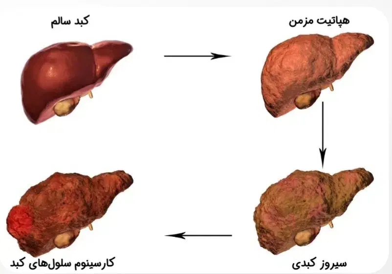 کبدچرب درمان شد*گیاهی*|آرایشی، بهداشتی، درمانی|قم, دورشهر|دیوار