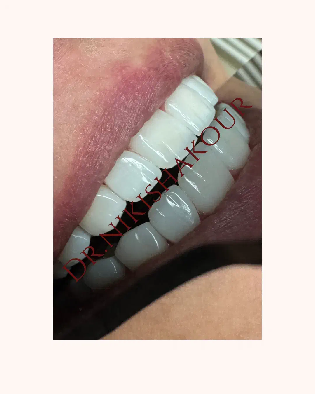 کامپوزیت لب شیشه‌ای با تخفیف محدود و ویزیت رایگان|خدمات آرایشگری و زیبایی|تهران, ونک|دیوار