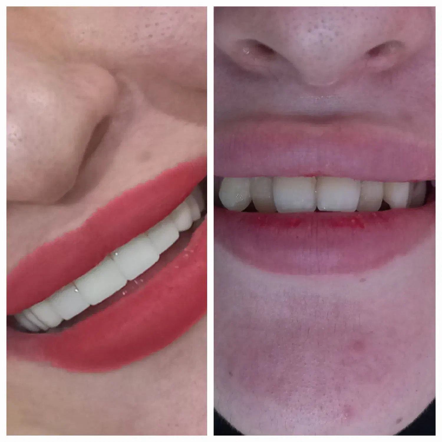 کامپوزیت دندان|خدمات آرایشگری و زیبایی|یاسوج, |دیوار