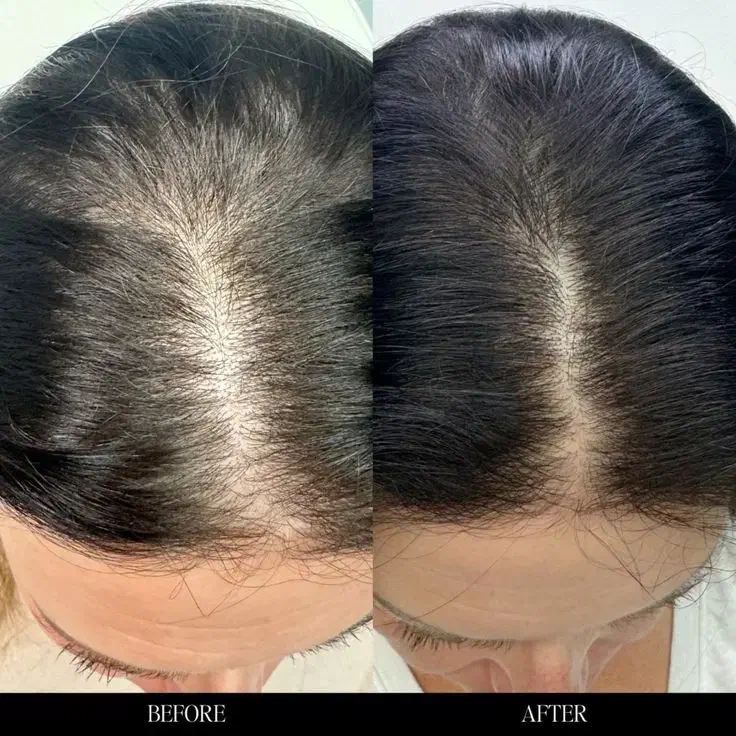 حل ریزش (تضمینی)|آرایشی، بهداشتی، درمانی|لار, |دیوار