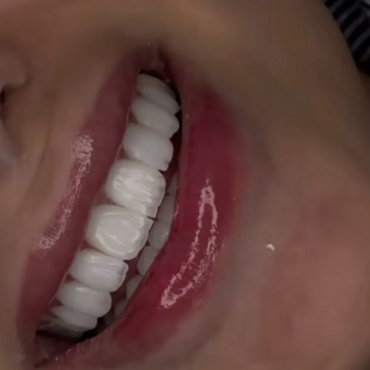 کامپوزیت دندان روکش لمینت با قیمت مناسب و اقساط|خدمات آرایشگری و زیبایی|ری, شهرری|دیوار