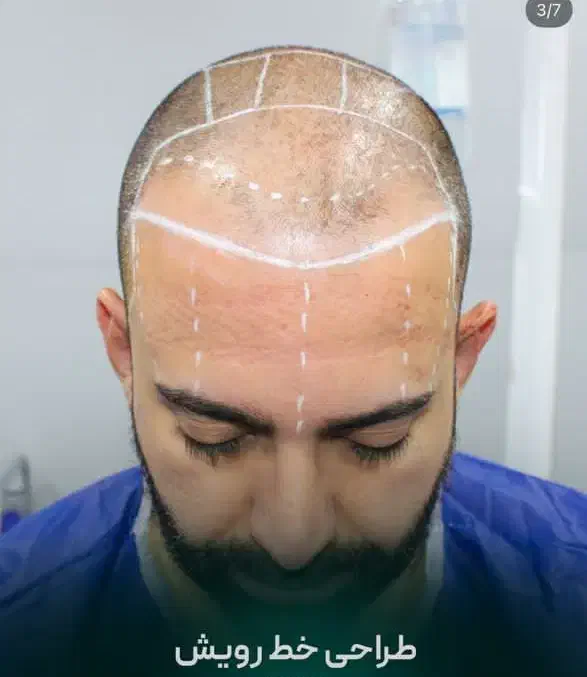 کاشت مو فقط در یک روز با ضمانت تراکم|خدمات آرایشگری و زیبایی|اصفهان, کشاورزی|دیوار