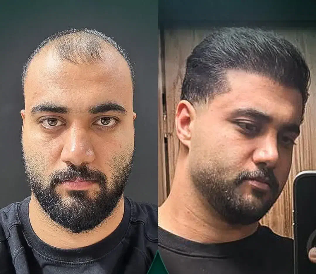 جشنواره کاشت مو پرتراکم تضمینی ۱۴ میلیون|خدمات آرایشگری و زیبایی|تهران, پاسداران|دیوار