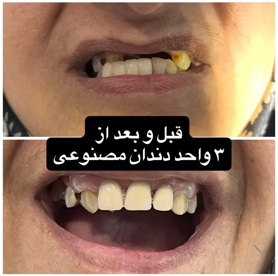 دندان سازی مروارید۳۰٪ اف|خدمات آرایشگری و زیبایی|بهبهان, |دیوار