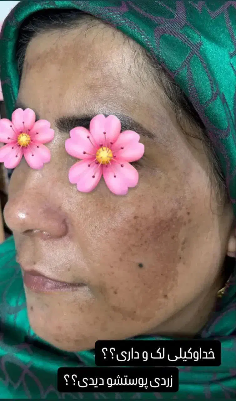 کرم ژل رویال بهترین ضدلک|آرایشی، بهداشتی، درمانی|قم, امامزاده ابراهیم|دیوار