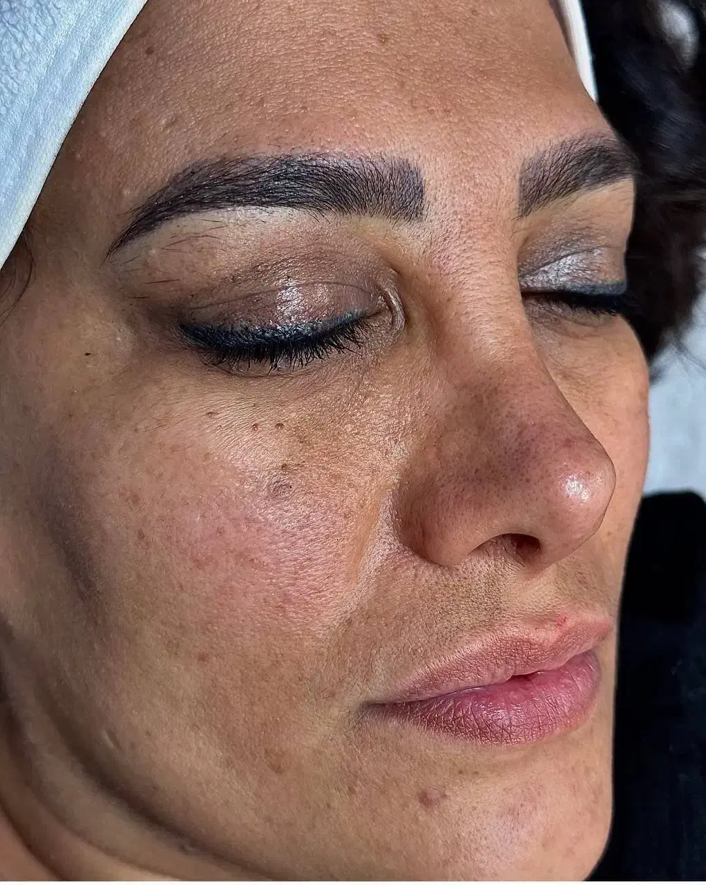 فیشال تخصصی زیر نظر پزشک|خدمات آرایشگری و زیبایی|مسجد سلیمان, |دیوار