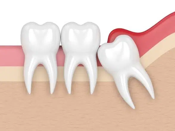 دندان عقل را بدون استرس بکش|خدمات زیبایی و سلامت|تهران, نیاوران|دیوار