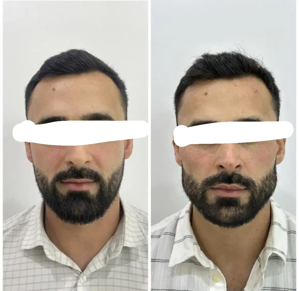 کانتور و فیلر و بوتاکس اقاو‌خانوم مدل رایگان|خدمات آرایشگری و زیبایی|هشتگرد, شهرک ولیعصر (مصلی)|دیوار
