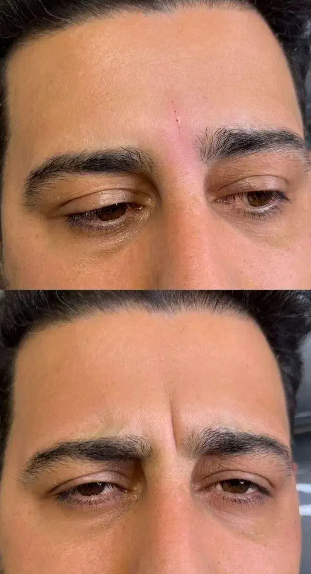 تزریق ژل و بوتاکس|خدمات آرایشگری و زیبایی|رشت, بوسار|دیوار