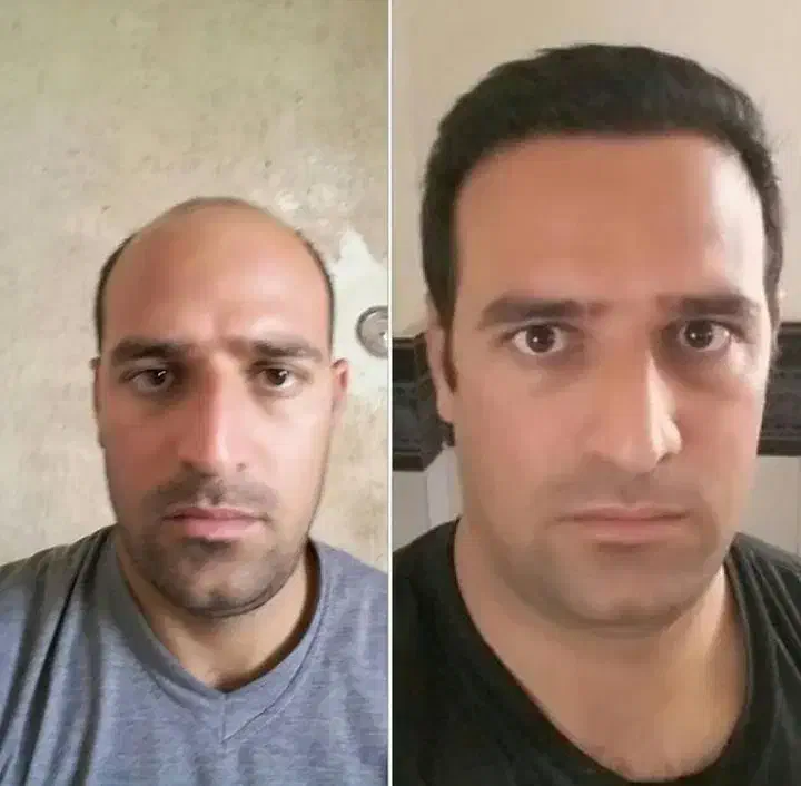 کاشت مو اقساط|خدمات آرایشگری و زیبایی|تهران, حشمتیه|دیوار