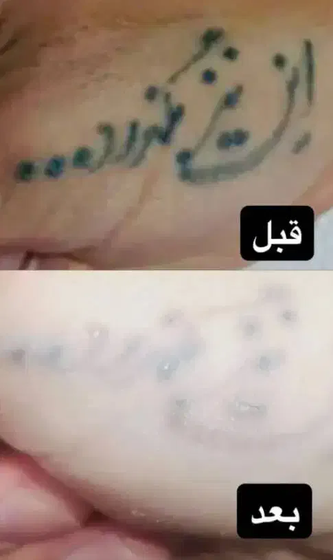 لیزر موهای زائد میکروسویچ و اپلومد کندلا وایتنینگ|خدمات آرایشگری و زیبایی|اصفهان, طامه|دیوار