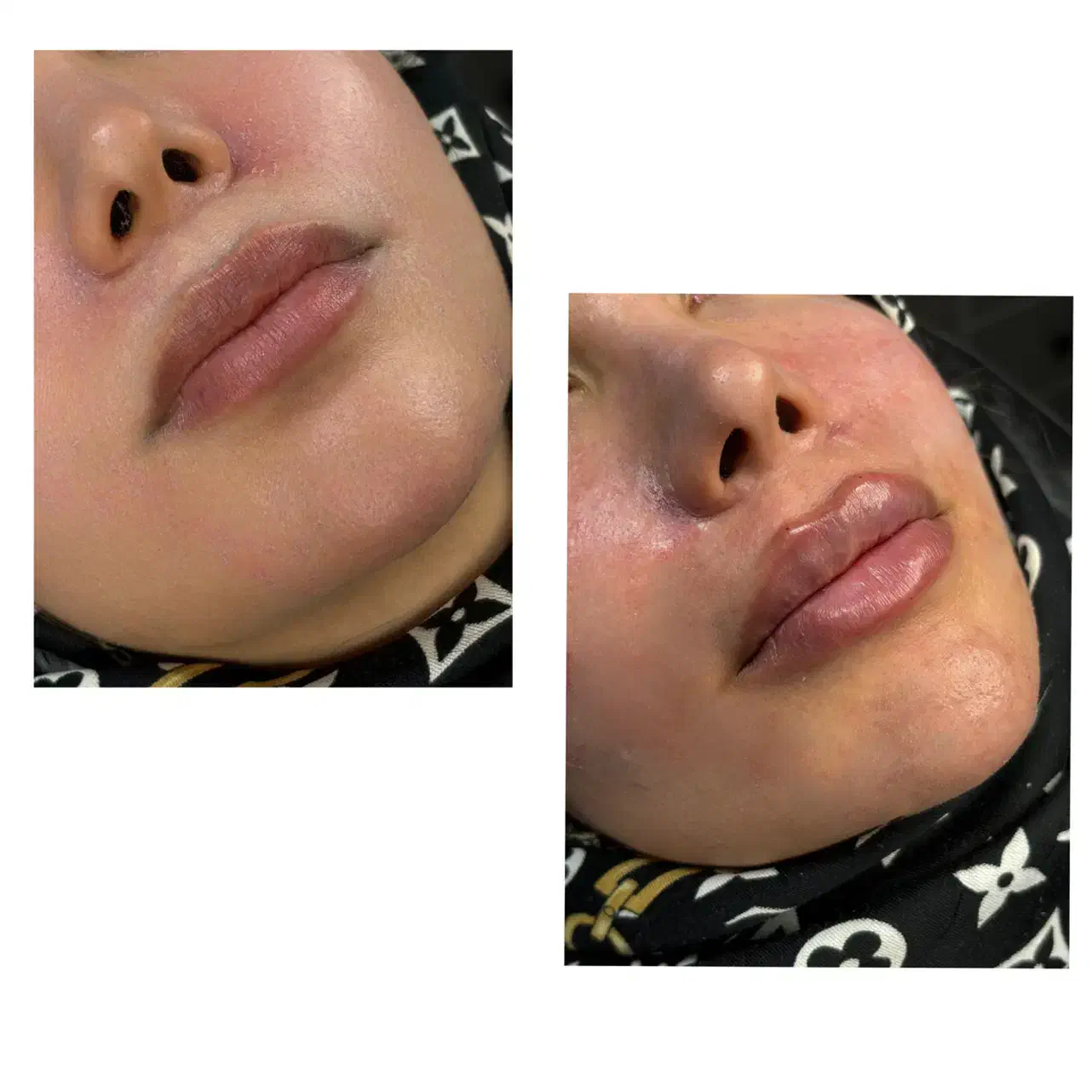 تزریقات زیبایی کلینیک زیبایی لاراتیس|خدمات آرایشگری و زیبایی|یاسوج, |دیوار