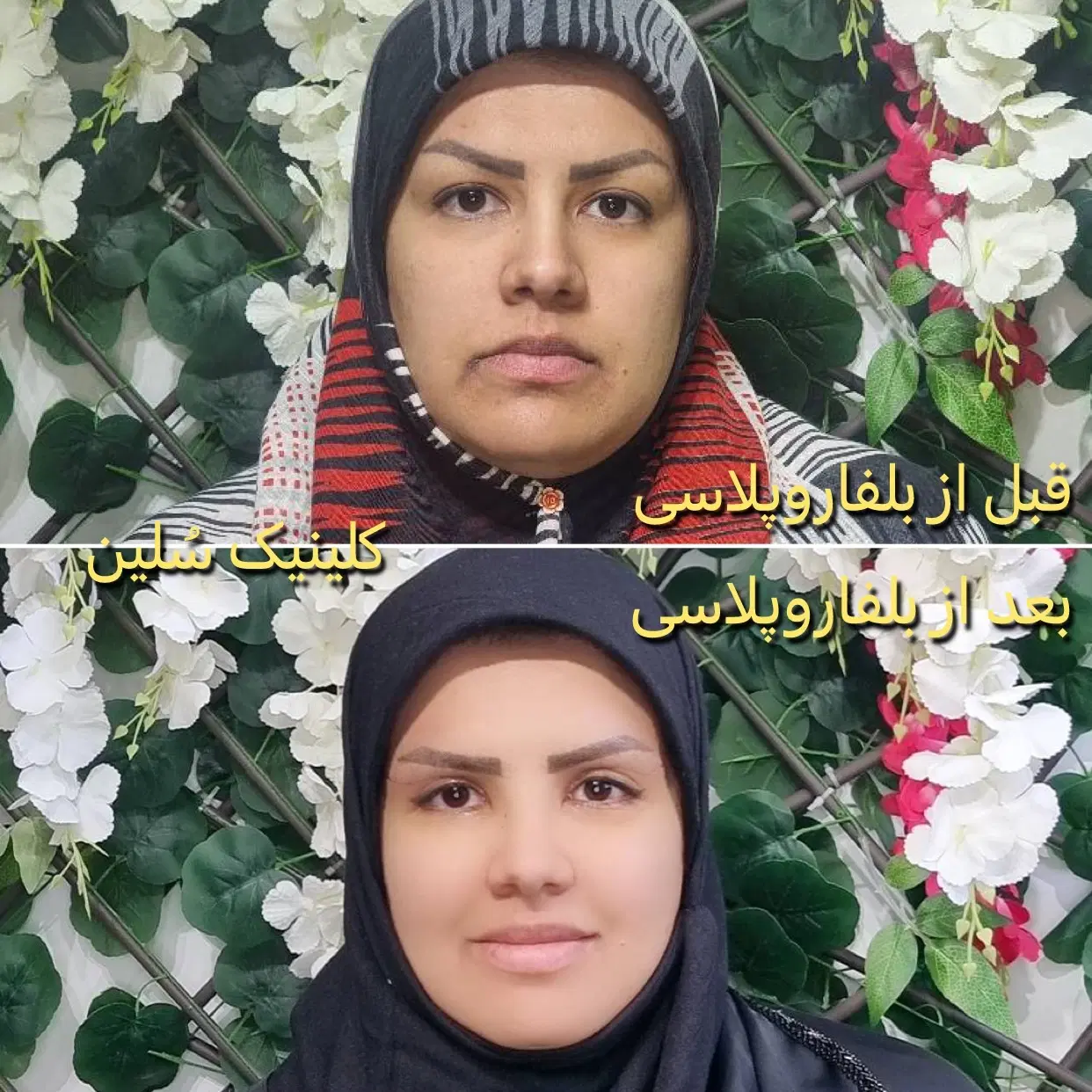عمل جراحی پلک(بلفاروپلاسی)جراحی گوش(اتوپلاسی)|خدمات زیبایی و سلامت|تهران, آبشار تهران (دریاچه)|دیوار
