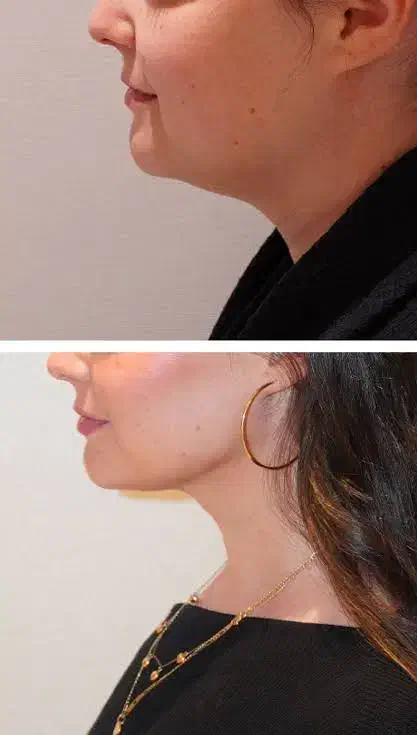 بلفاروپلاستی،بوکال فت،لیفت سانترال لب،لیپوست غبغب|خدمات آرایشگری و زیبایی|گرگان, |دیوار