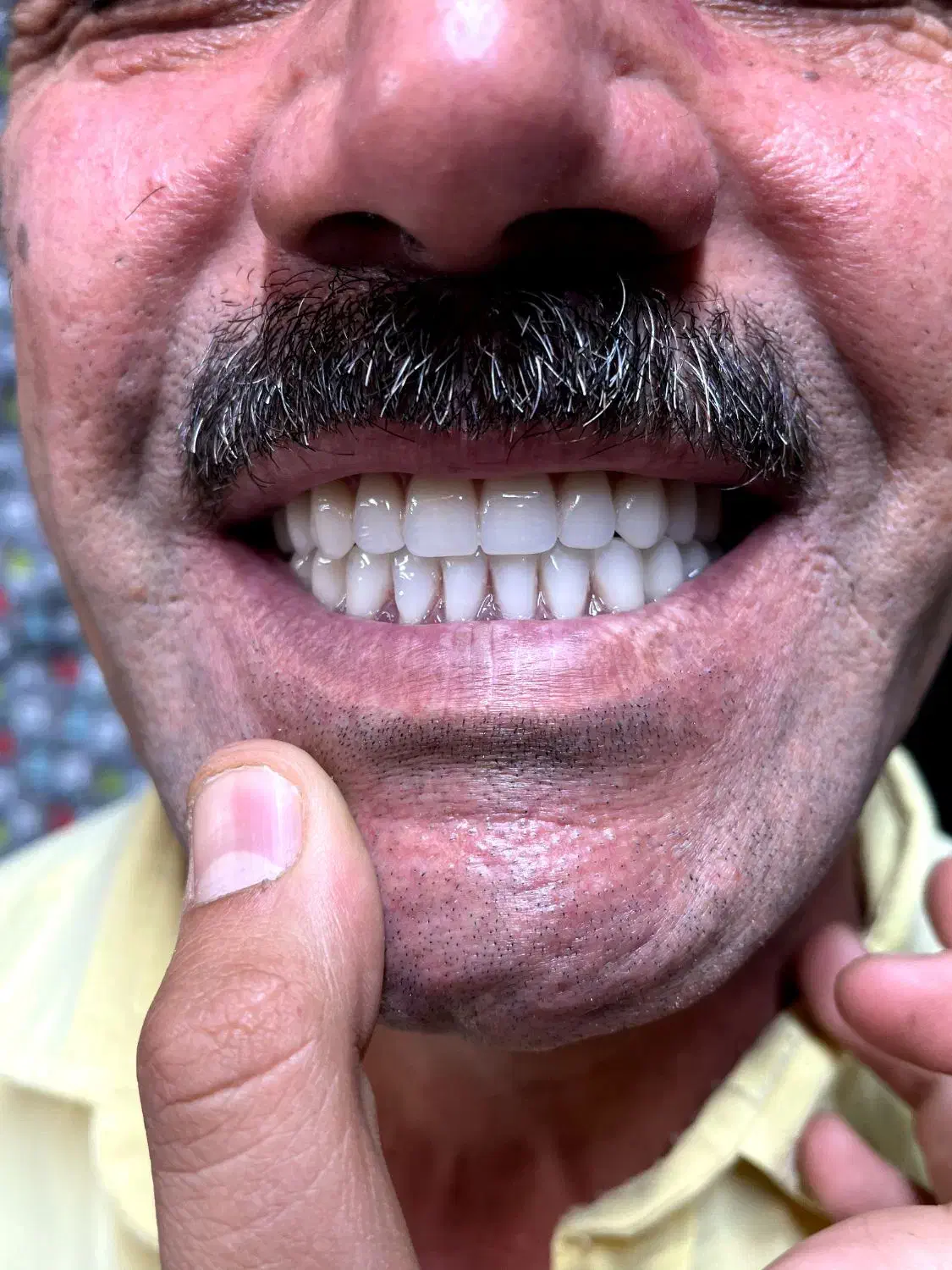 دست دندان مصنوعی و پروتز متحرک|خدمات آرایشگری و زیبایی|اصفهان, شهرک کاوه|دیوار