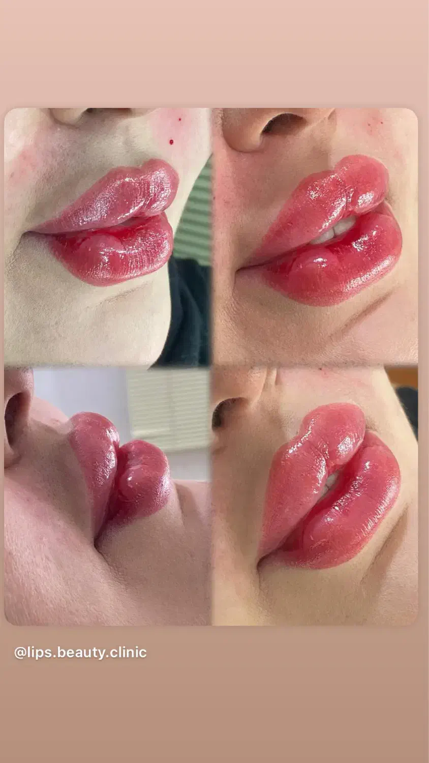 تخفیف ویژه یلدایی بوتاکس و‌فیلر(ژل)|خدمات آرایشگری و زیبایی|ارومیه, |دیوار