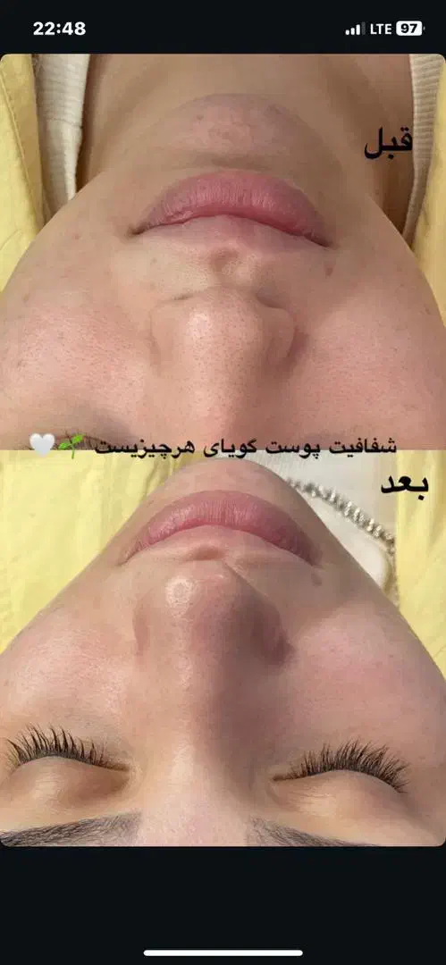 فیشال و جوانسازی پوست|خدمات آرایشگری و زیبایی|قائمشهر, |دیوار