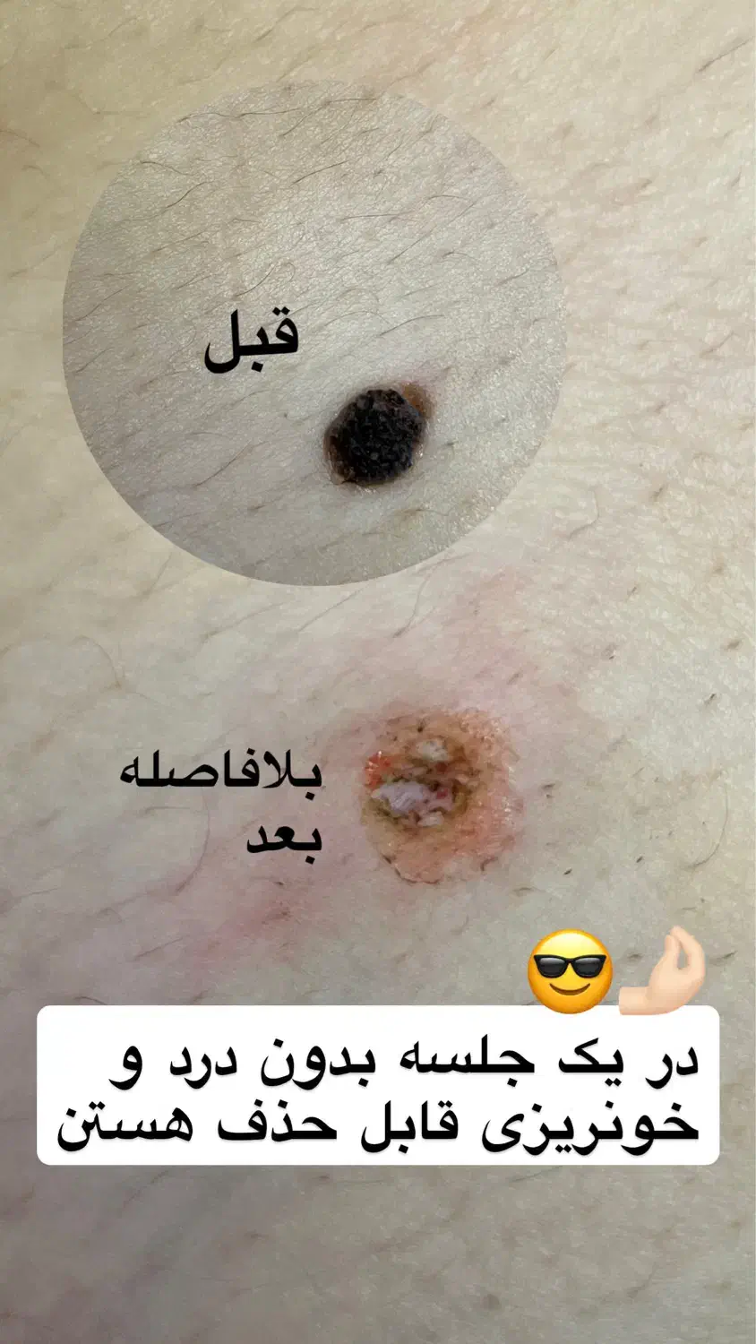 برداشتن خال و زگیل در یک جلسه|خدمات آرایشگری و زیبایی|گرگان, |دیوار