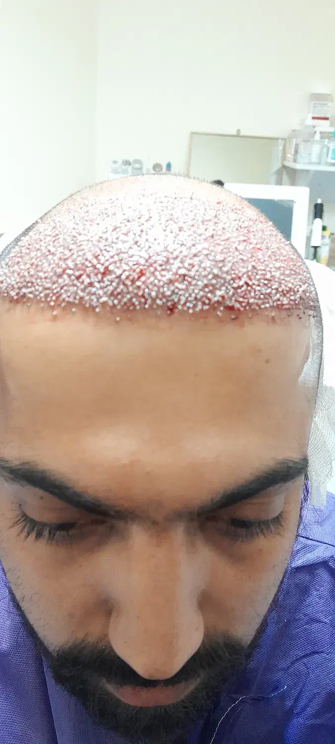 کاشت مو / ریش|خدمات آرایشگری و زیبایی|خرمآباد, |دیوار