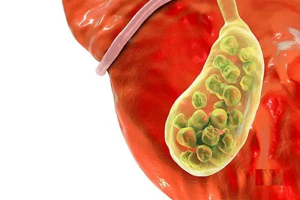 خارج کردن و دفع سنگ صفرا بدون عمل|آرایشی، بهداشتی، درمانی|اهواز, طالقانی|دیوار