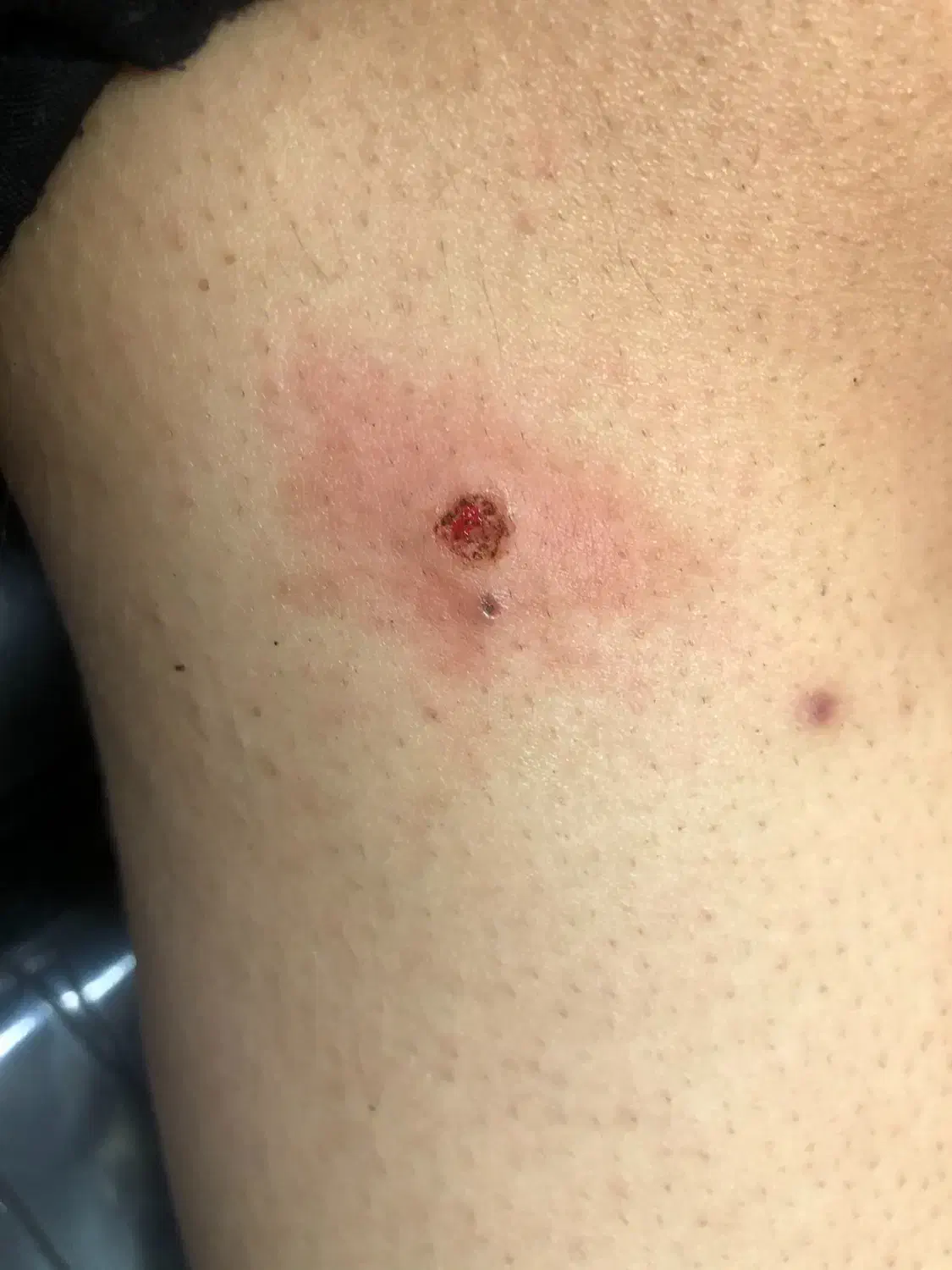 حذف انواع خال (گوشتی،سطحی،زیگیل)|خدمات آرایشگری و زیبایی|کاشان, فاز ۲ ناجی آباد|دیوار