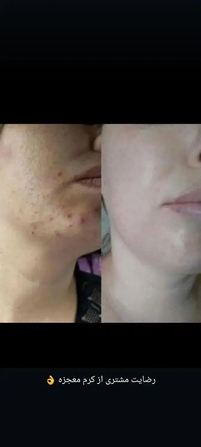 روشن کننده صورت و دست معجزه بشرط اصلی و گیاهی|آرایشی، بهداشتی، درمانی|یاسوج, |دیوار