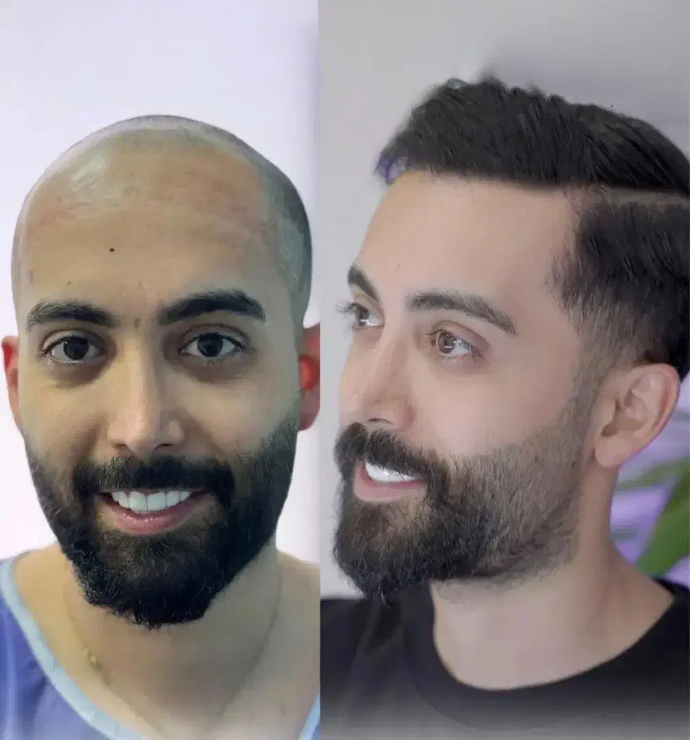 کاشت مو و ابرو|خدمات آرایشگری و زیبایی|رشت, بوسار|دیوار