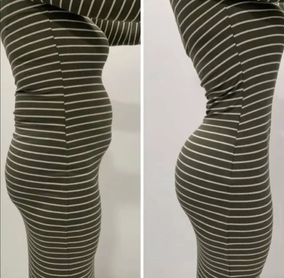 لیپو فقط ۳۰ت/ لیپوماتیک ابدو پروتز مامو لیفت سینه|خدمات آرایشگری و زیبایی|تهران, زعفرانیه|دیوار