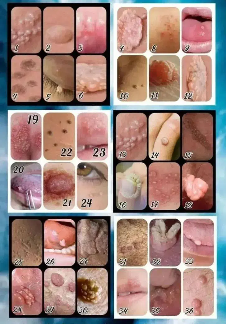 درمان با تضمین زگیل و تبخال|خدمات آرایشگری و زیبایی|آمل, |دیوار