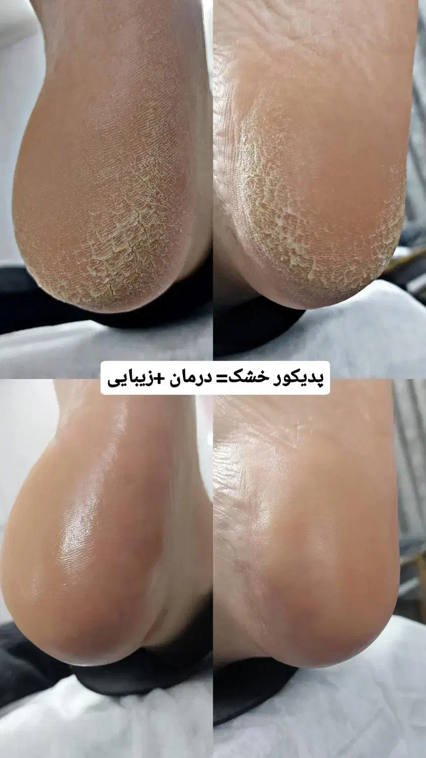 پدیکور کلینیکال درمانی|خدمات آرایشگری و زیبایی|قم, زنبیل آباد|دیوار