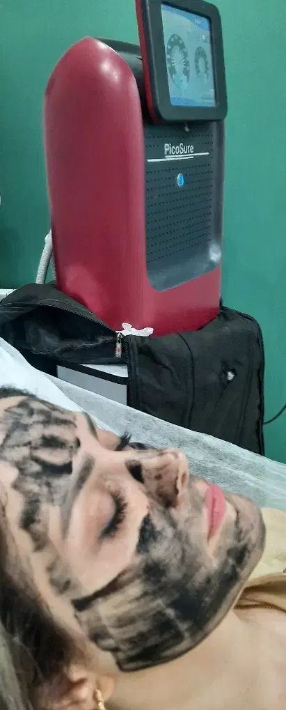 لیزر کیوسوئیچ (رفع لک صورت.رفع لک زیربغل.رفع تتو)|خدمات آرایشگری و زیبایی|رشت, پورسینا|دیوار