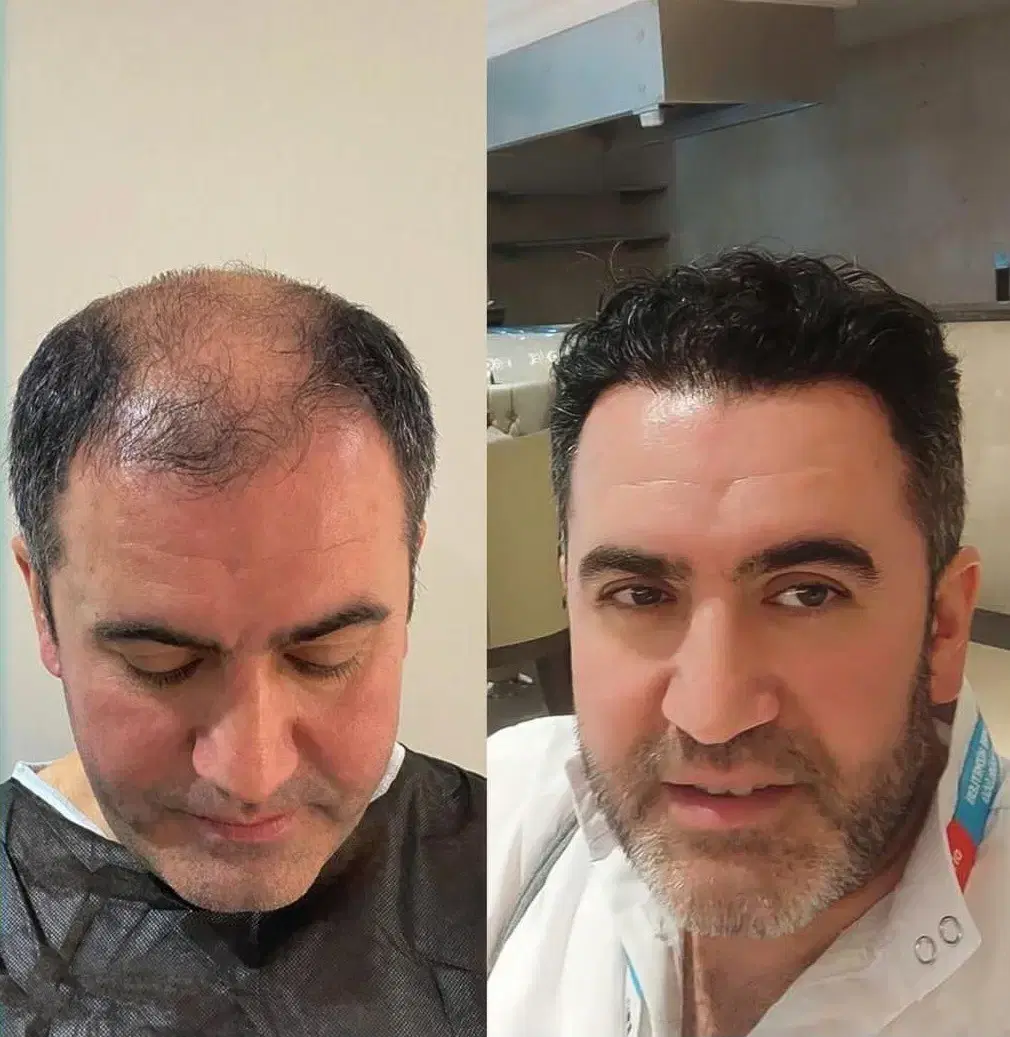کاشت مو و ابرو وجراحی پلک باضمانتنانه وتمام اقساط|خدمات زیبایی و سلامت|تهران, نارمک|دیوار