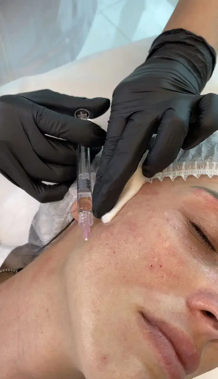 جوانسازی صورت|آرایشی، بهداشتی، درمانی|شاهین‌شهر, فردوسی|دیوار