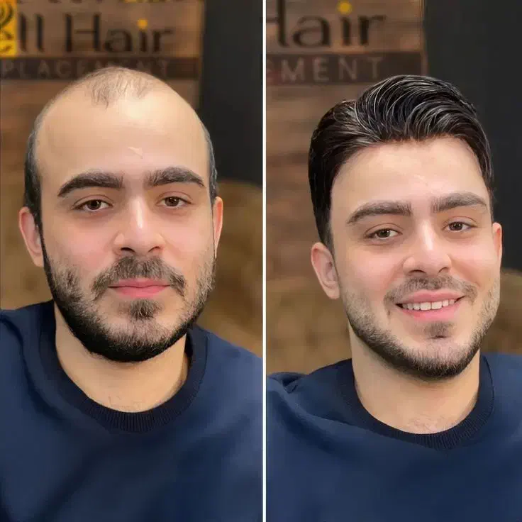 کاشت موی تضمینی با خط رویش 100٪ طبیعی|خدمات آرایشگری و زیبایی|شهرکرد, |دیوار