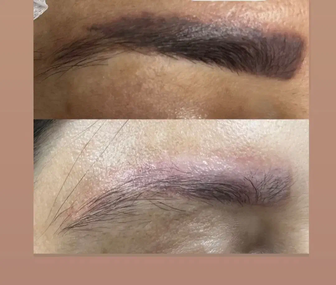 ریموو تخصصی درتربت جام|خدمات آرایشگری و زیبایی|تربت جام, والفجر|دیوار