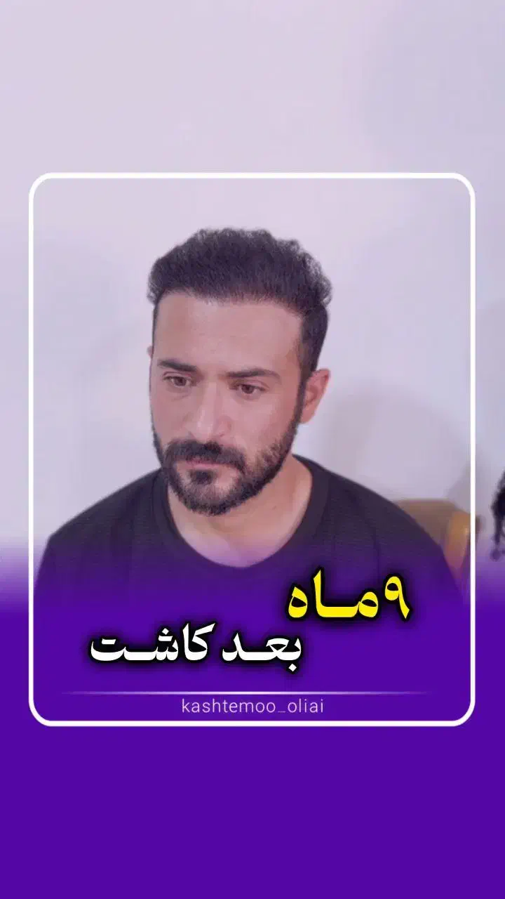 کاشت مو و ابرو|خدمات آرایشگری و زیبایی|قم, پامنار|دیوار