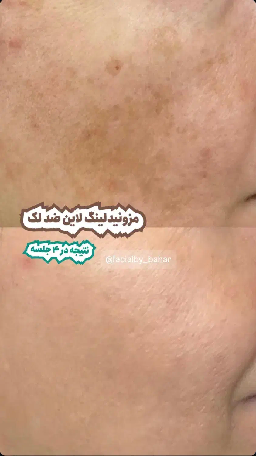 مزونیدلینگ حرفه‌ای در کلینیک زیبایی/هاشمیه|خدمات آرایشگری و زیبایی|مشهد, چهارچشمه|دیوار