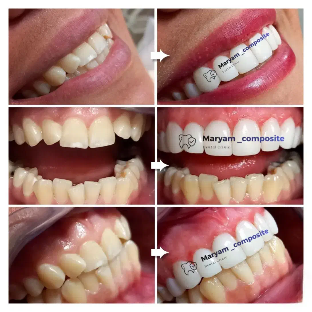 کامپوزیت دندان تعرفه دولتی|خدمات آرایشگری و زیبایی|کارون, |دیوار