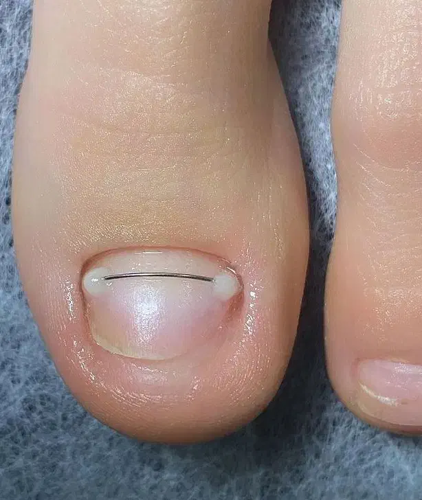 خارج کردن ناخن از داخل گوشت  و نصب ارتونیل|خدمات آرایشگری و زیبایی|مشهد, شهرک امام هادی (شهرک غرب)|دیوار