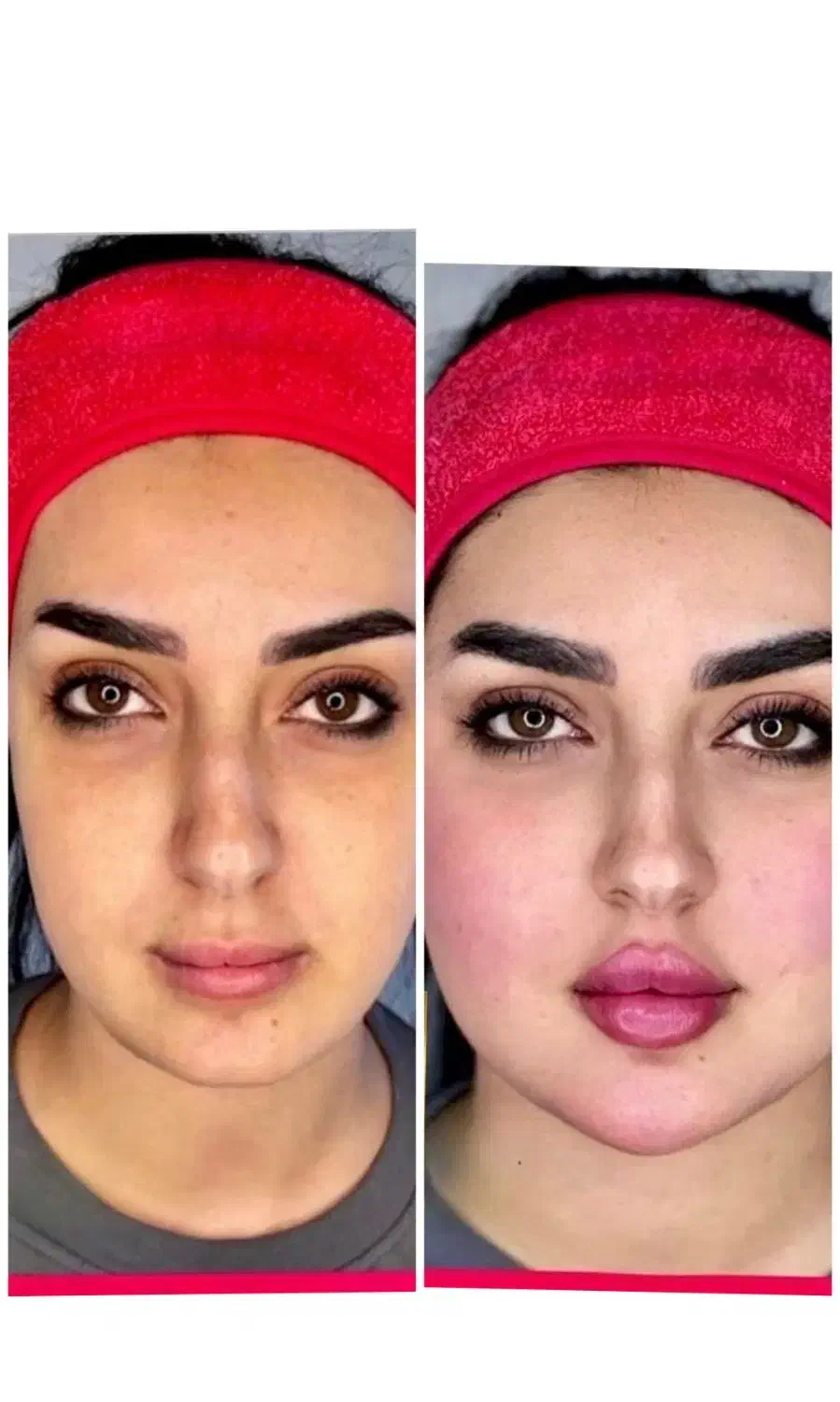 هایفو و جوانسازی پوست ویژه جشنواره یلدا ۸۹۰ت|خدمات آرایشگری و زیبایی|اصفهان, پروین|دیوار